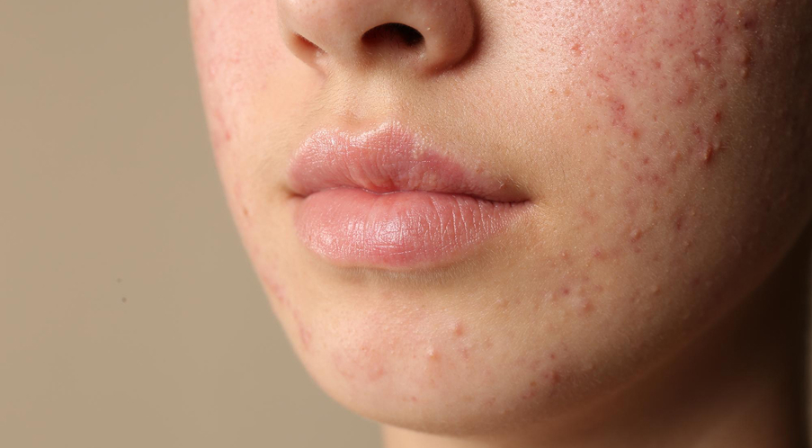 Acne & Excess Androgen Care